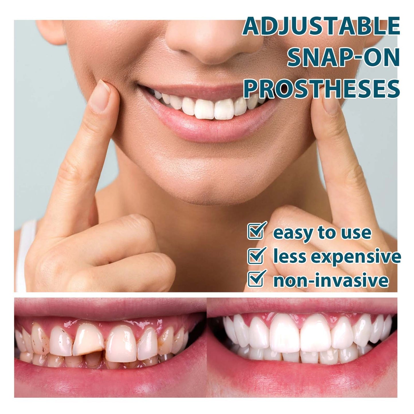 Adjustable Custom-Adaptive Denture System Snap-on Dentures