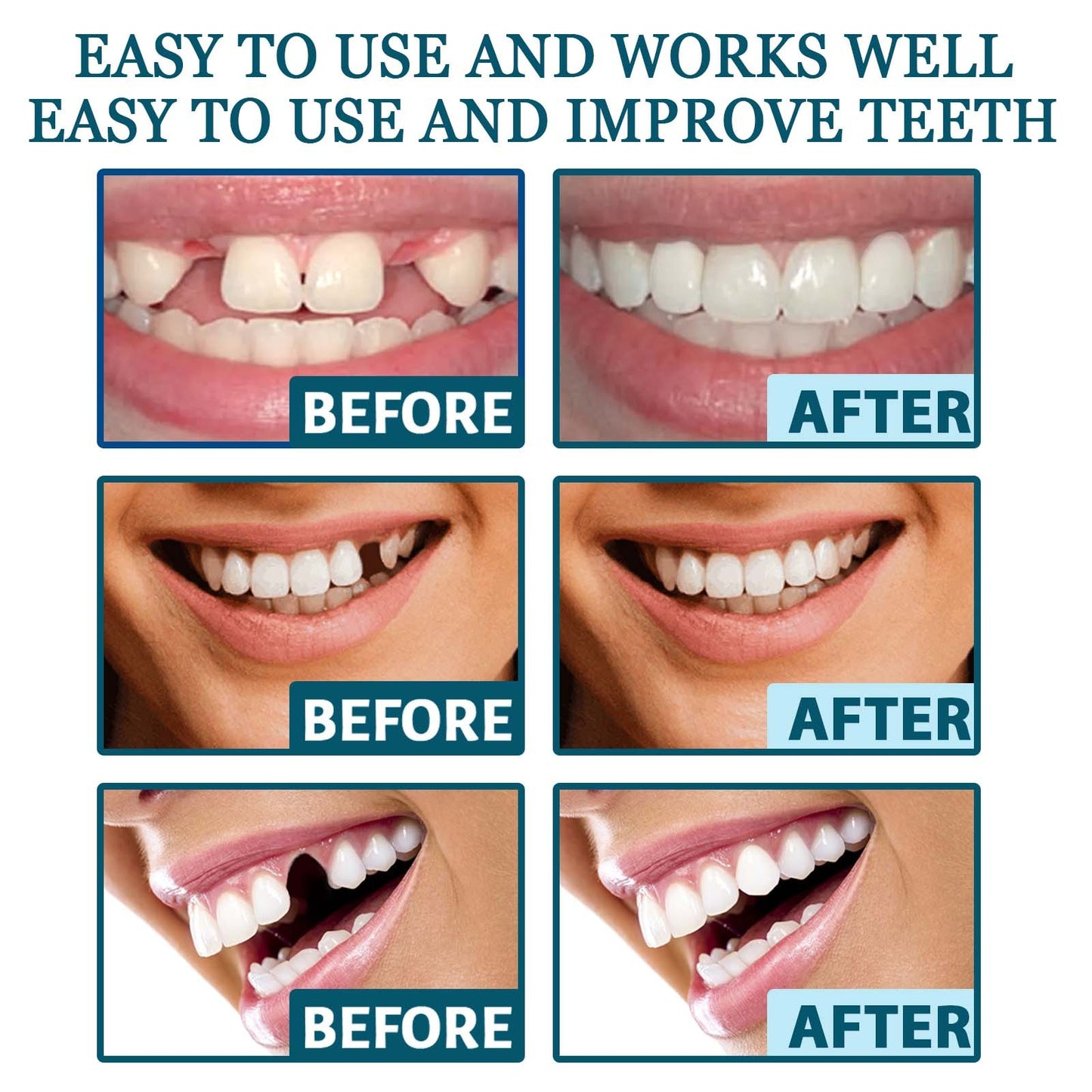 Adjustable Custom-Adaptive Denture System Snap-on Dentures