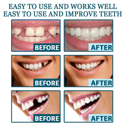 Adjustable Custom-Adaptive Denture System Snap-on Dentures